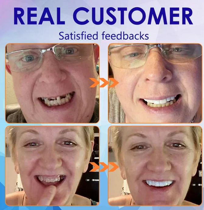 EverSmile™ Teeth Veneers