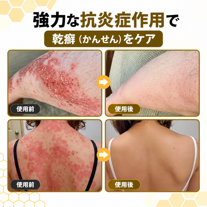 Timlk PsoriaSoothe – 蜂毒配合スキンケアクリーム